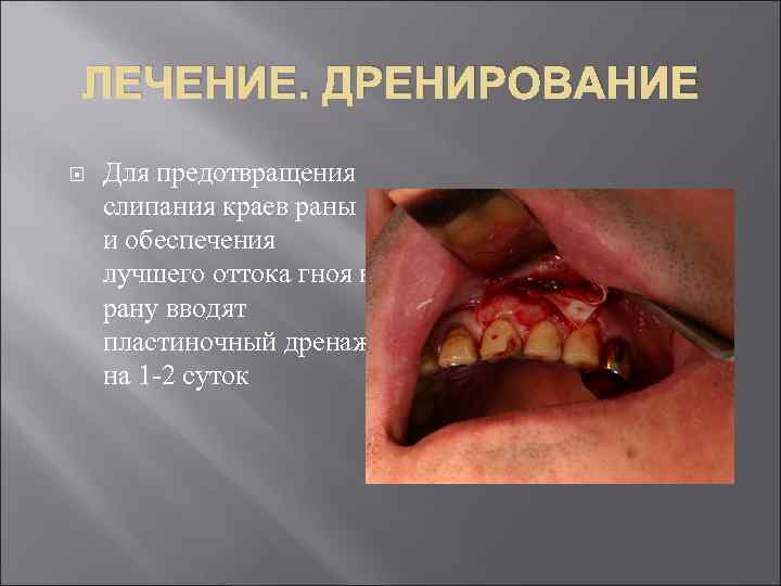 ЛЕЧЕНИЕ. ДРЕНИРОВАНИЕ Для предотвращения слипания краев раны и обеспечения лучшего оттока гноя в рану