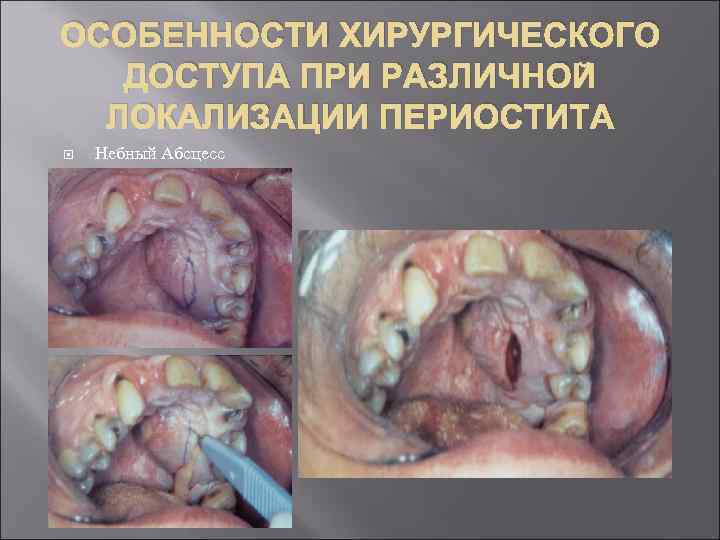 ОСОБЕННОСТИ ХИРУРГИЧЕСКОГО ДОСТУПА ПРИ РАЗЛИЧНОЙ ЛОКАЛИЗАЦИИ ПЕРИОСТИТА Небный Абсцесс 