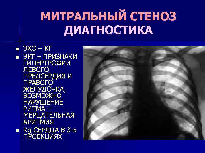 Рентгенологическая картина при митральном стенозе