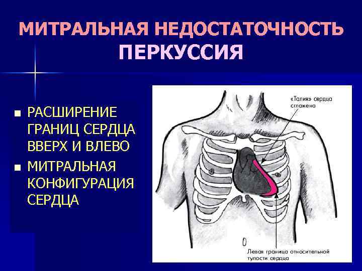 Митральная недостаточность презентация