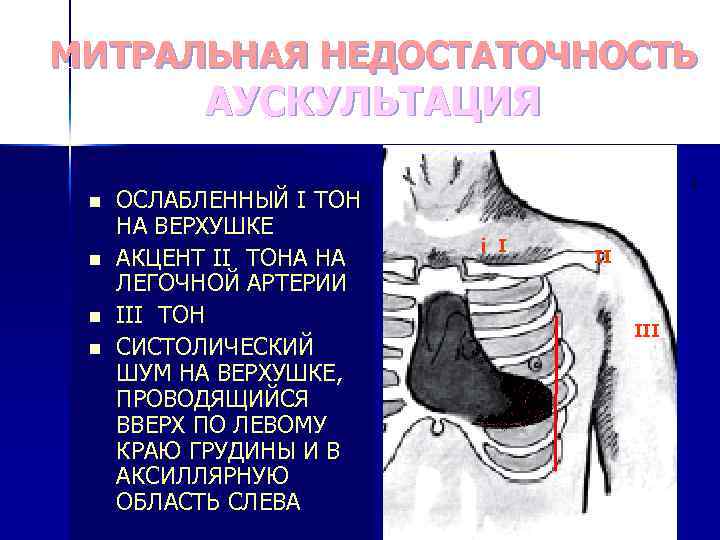 Шум при митральной недостаточности