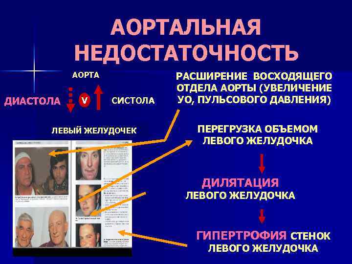 АОРТАЛЬНАЯ НЕДОСТАТОЧНОСТЬ АОРТА ДИАСТОЛА V CИСТОЛА ЛЕВЫЙ ЖЕЛУДОЧЕК РАСШИРЕНИЕ ВОСХОДЯЩЕГО ОТДЕЛА АОРТЫ (УВЕЛИЧЕНИЕ УО,