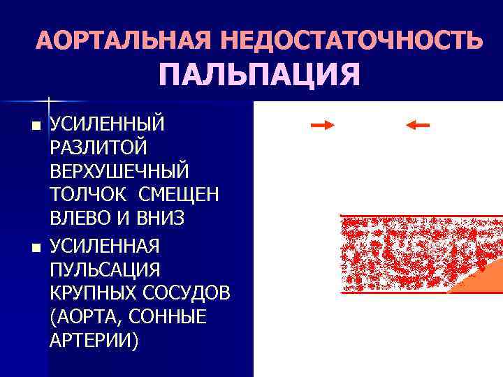 Аортальная недостаточность презентация