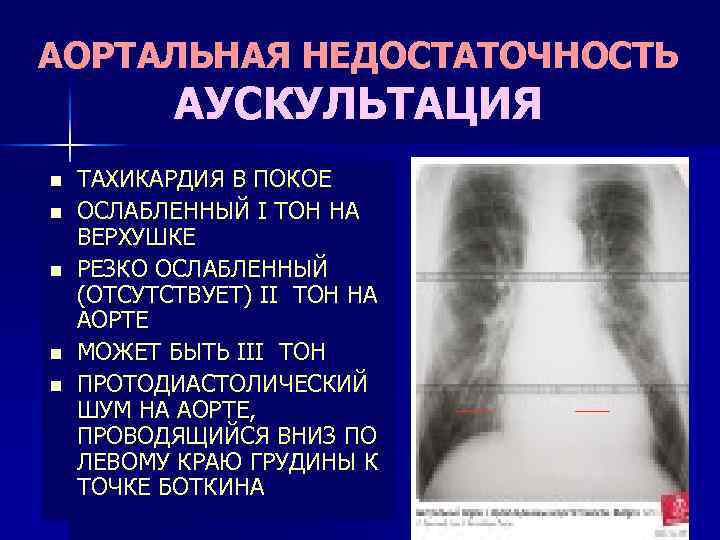 Аортальная недостаточность презентация