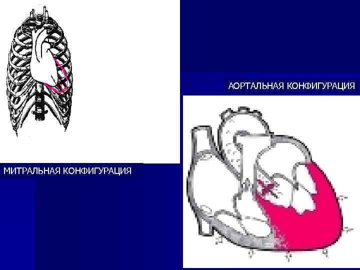 АОРТАЛЬНАЯ КОНФИГУРАЦИЯ МИТРАЛЬНАЯ КОНФИГУРАЦИЯ 