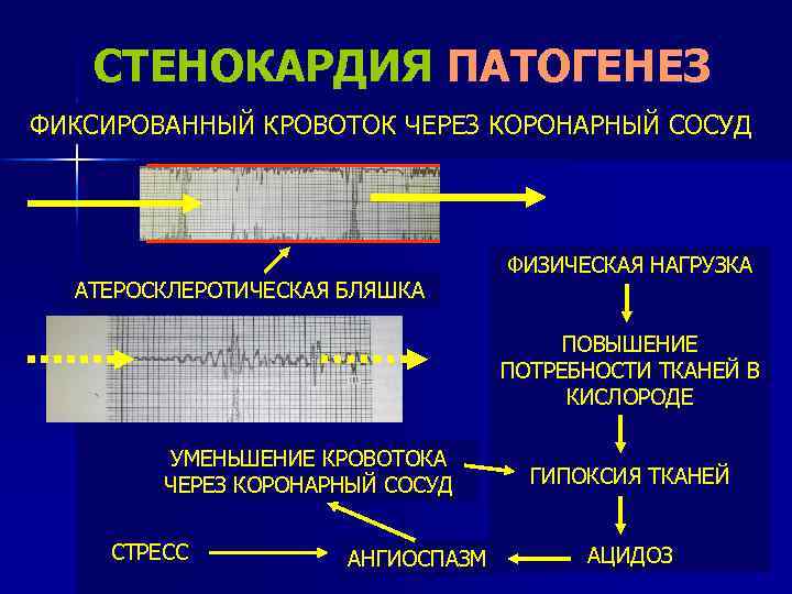 Стенокардия этиология