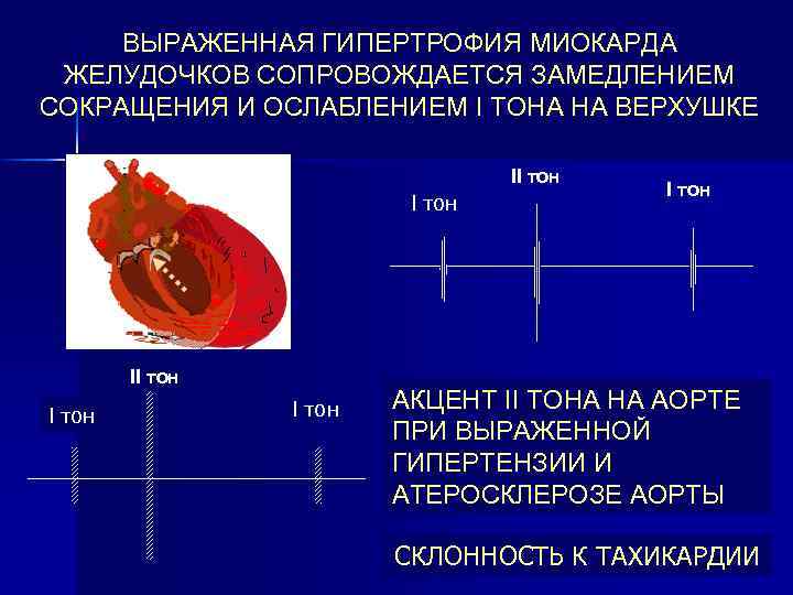 ВЫРАЖЕННАЯ ГИПЕРТРОФИЯ МИОКАРДА ЖЕЛУДОЧКОВ СОПРОВОЖДАЕТСЯ ЗАМЕДЛЕНИЕМ СОКРАЩЕНИЯ И ОСЛАБЛЕНИЕМ I ТОНА НА ВЕРХУШКЕ II