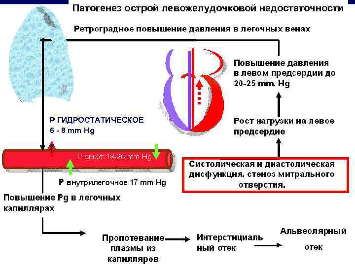 Патогенез острой левожелудочковой недостаточности Р ГИДРОСТАТИЧЕСКОЕ 6 - 8 mm Hg 