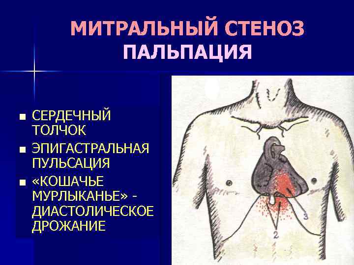 Фото митральный стеноз