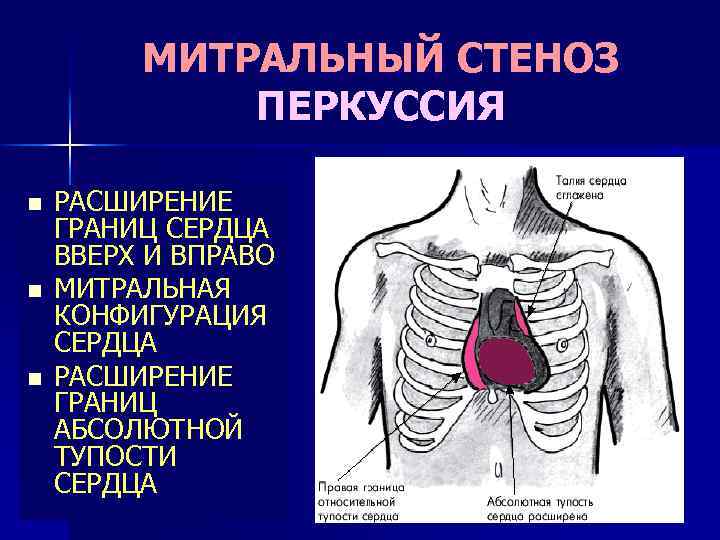 Аускультативная картина при митральном стенозе сердца включает