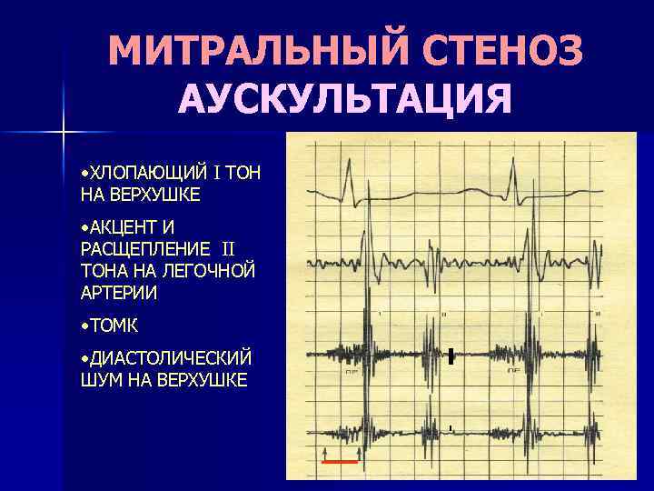 Аускультативная картина митрального стеноза тест