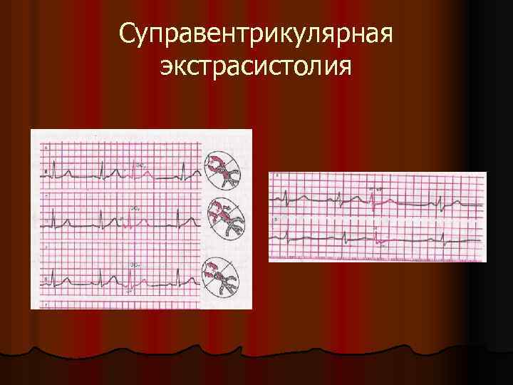 Суправентрикулярная экстрасистолия 