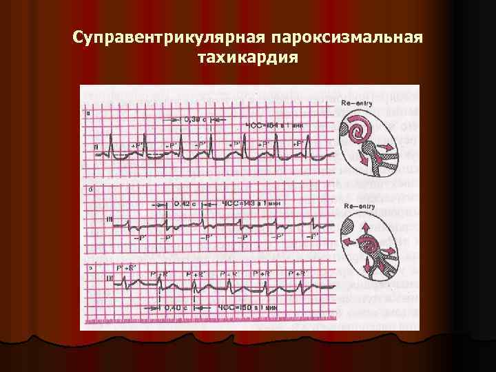 Суправентрикулярная пароксизмальная тахикардия 