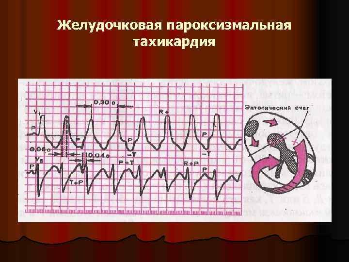 Желудочковая пароксизмальная тахикардия 