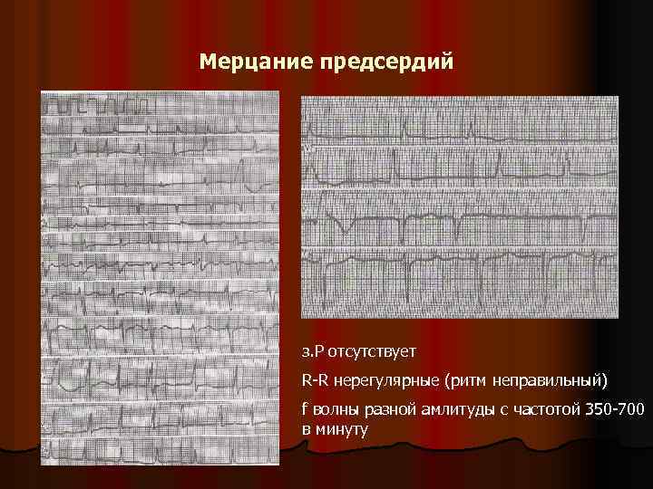 Мерцание предсердий з. P отсутствует R-R нерегулярные (ритм неправильный) f волны разной амлитуды с