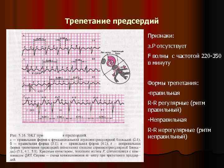 Трепетание предсердий. Трепетание предсердий ЧСС. Трепетание предсердий регулярная форма. Ритм трепетания предсердий. Волны f при трепетании предсердий.