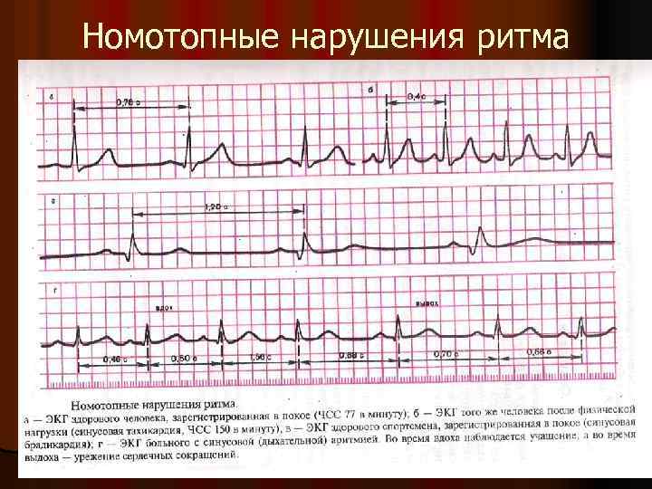 Номотопные нарушения ритма 