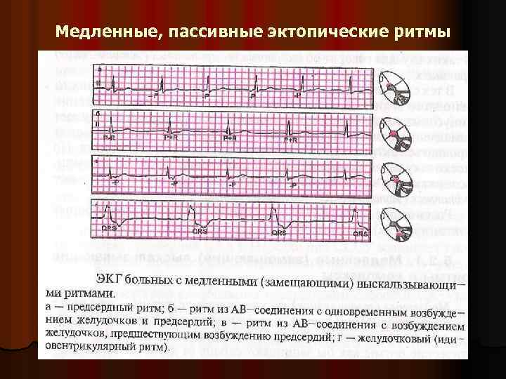 Медленные, пассивные эктопические ритмы 
