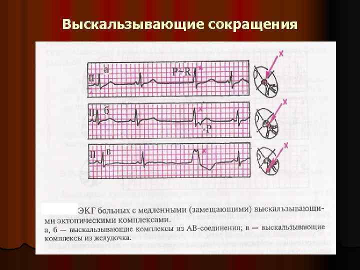 Комплексы экг