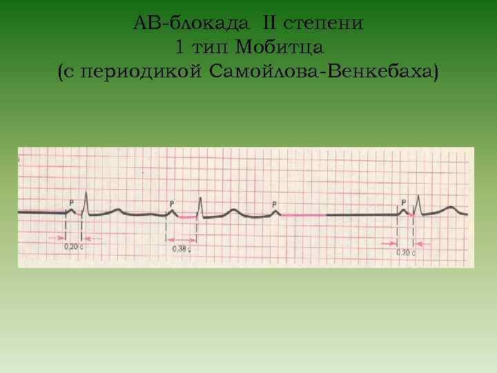 Ав блокада 2 степени. АВ-блокада 2 степени Венкебаха. АВ блокада 2 степени Самойлова Венкебаха. AВ блокады 2 степени с периодами Самойлова Венкебаха. Av блокада 2 степени Тип Мобитца.