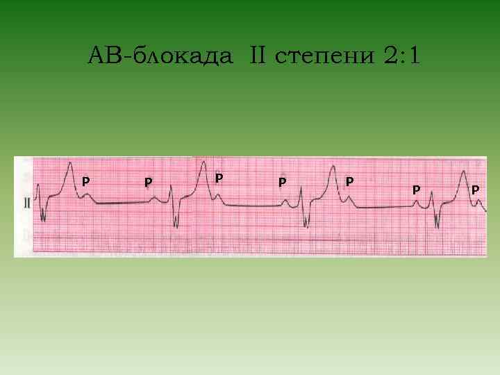 Ав блокада 2 степени. АВ блокада 2:1. АВ блокада 2 степени Мобитц 2 2 к 1. Неполная АВ блокада 2 степени Мобитц 1. АВ блокада 2 к 1 на ЭКГ.