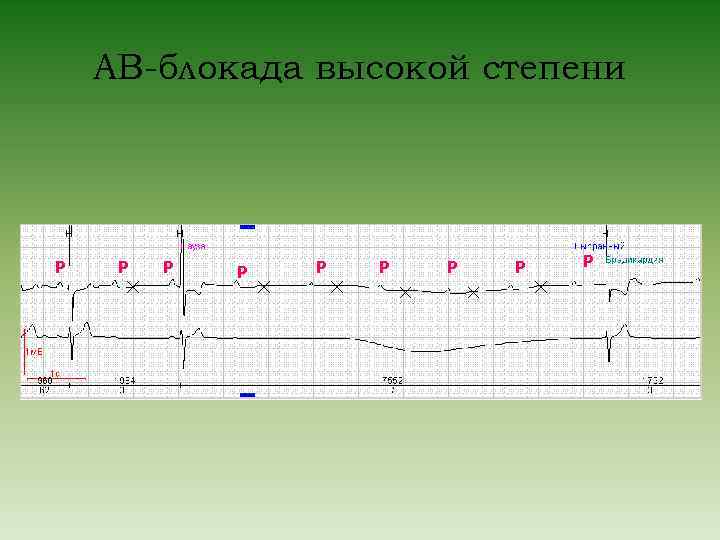 Ав блокада презентация