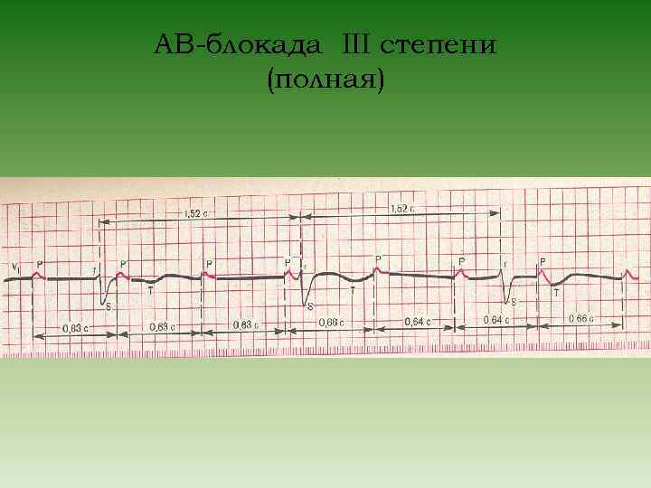 АВ-блокада III степени (полная) 