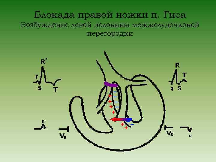 Блокада правой ножки п. Гиса Возбуждение левой половины межжелудочковой перегородки 