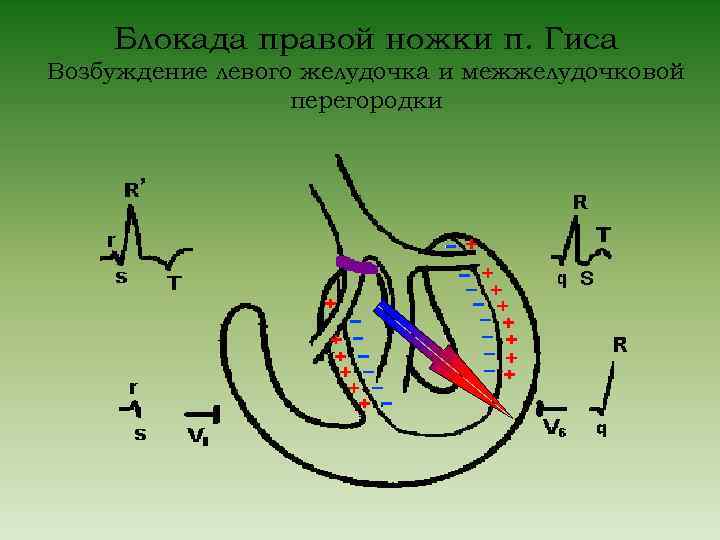 Блокада правой ножки п. Гиса Возбуждение левого желудочка и межжелудочковой перегородки 