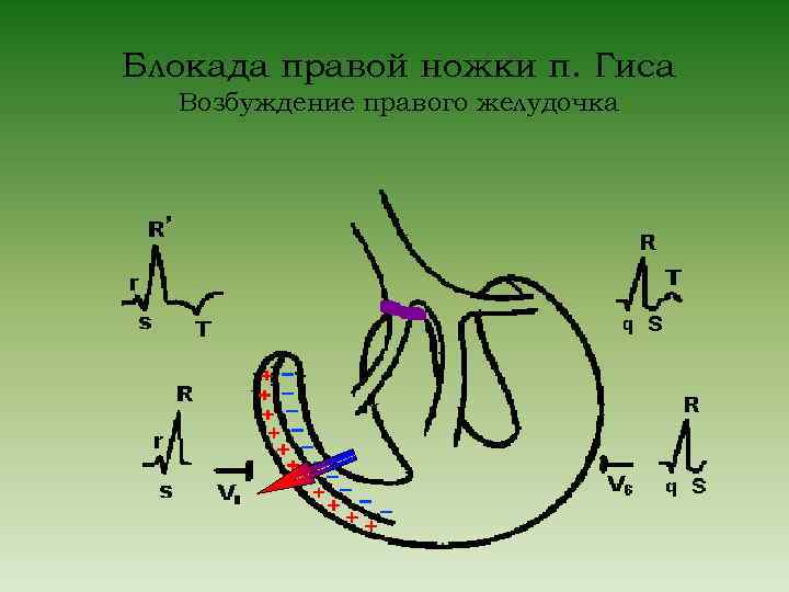 Блокада правой ножки п. Гиса Возбуждение правого желудочка 