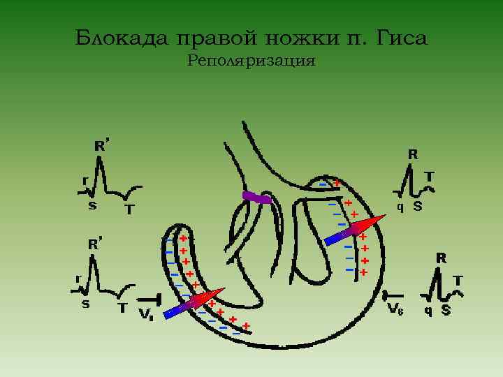Блокада правой ножки п. Гиса Реполяризация 