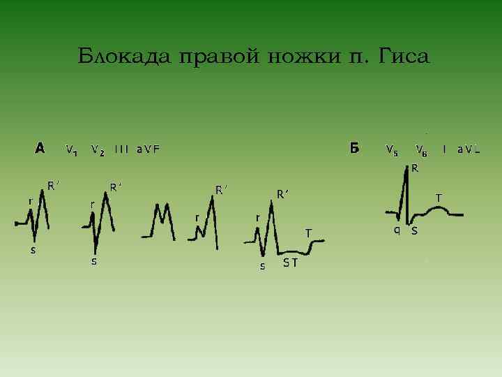 Блокада правой ножки п. Гиса 