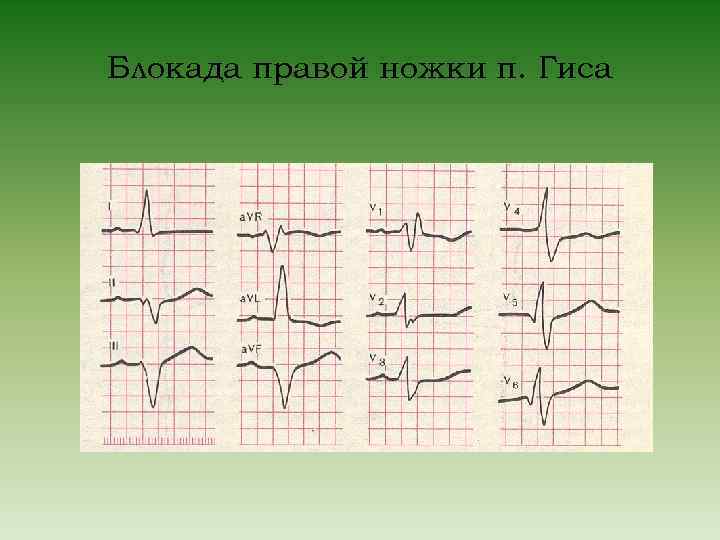 Блокада правой ножки п. Гиса 