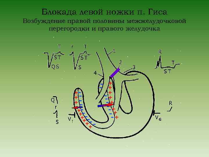 Блокада левой ножки п. Гиса Возбуждение правой половины межжелудочковой перегородки и правого желудочка -