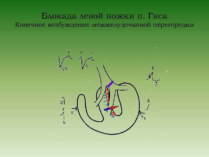 Блокада левой ножки п. Гиса Конечное возбуждение межжелудочковой перегородки + + --+ 