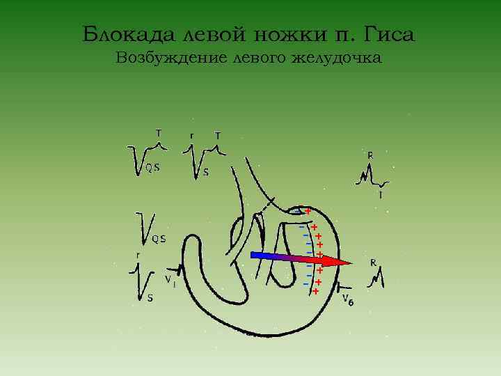 Блокада левой ножки п. Гиса Возбуждение левого желудочка -+ -- + + 