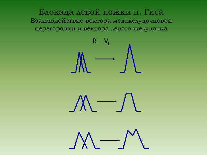 Блокада левой ножки п. Гиса Взаимодействие вектора межжелудочковой перегородки и вектора левого желудочка R