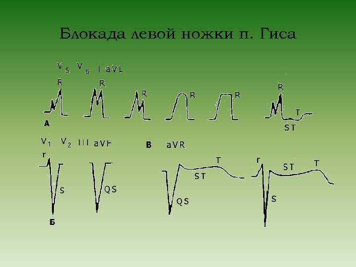 Блокада левой ножки п. Гиса 
