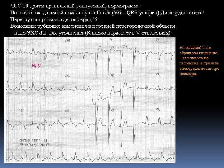 ЧСС 80 , ритм правильный , синусовый, нормограмма Полная блокада левой ножки пучка Гисса