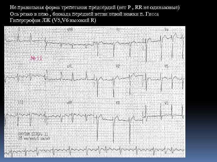 Не правильная форма трепетания предсердий (нет Р , RR не одинаковые) Ось резко в