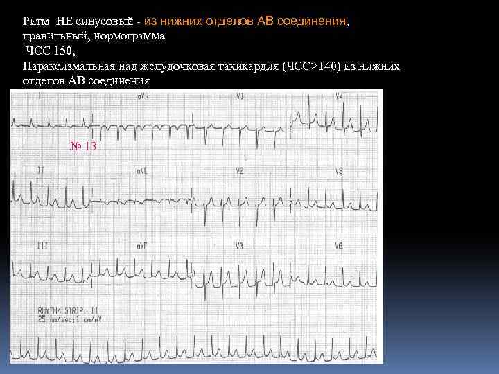 Ритм НЕ синусовый из нижних отделов АВ соединения, правильный, нормограмма ЧСС 150, Параксизмальная над