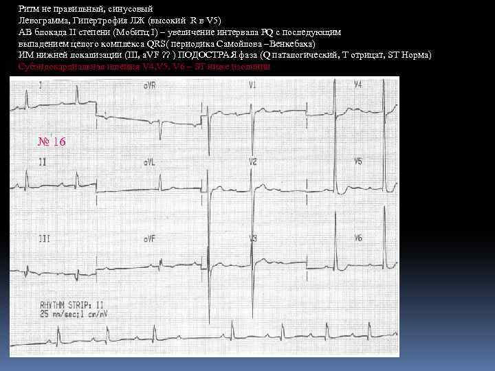 Ритм не правильный, синусовый Левограмма, Гипертрофия ЛЖ (высокий R в V 5) АВ блокада