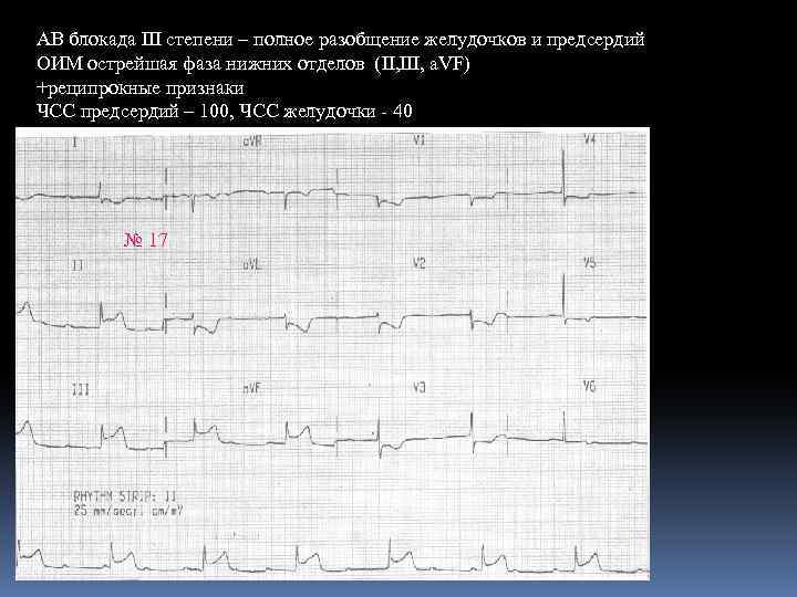 АВ блокада III степени – полное разобщение желудочков и предсердий ОИМ острейшая фаза нижних