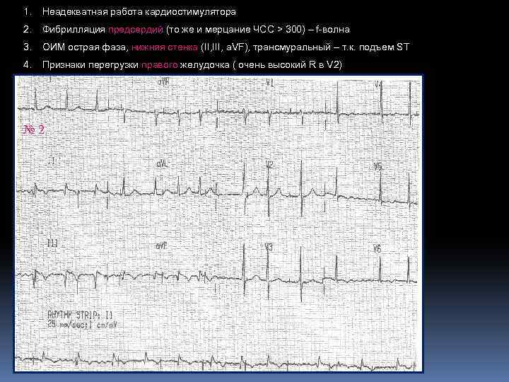 1. Неадекватная работа кардиостимулятора 2. Фибрилляция предсердий (то же и мерцание ЧСС > 300)
