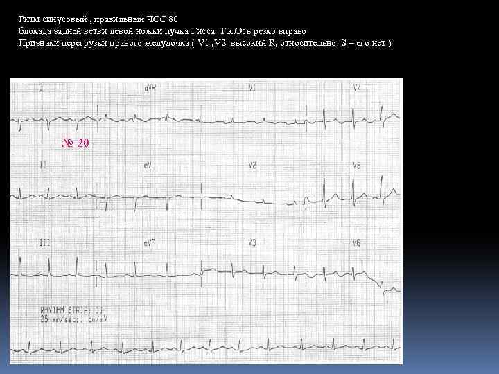 Ритм синусовый , правильный ЧСС 80 блокада задней ветви левой ножки пучка Гисса Т.