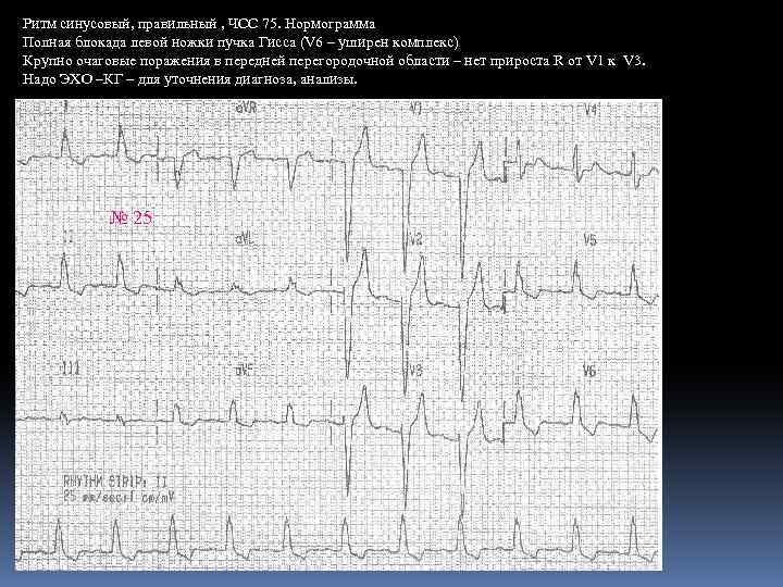 Ритм синусовый, правильный , ЧСС 75. Нормограмма Полная блокада левой ножки пучка Гисса (V