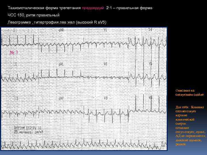 Тахисисталическая форма трепетания предсердий 2: 1 – правильная форма ЧСС 150, ритм правильный Левограмма