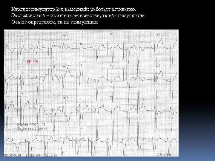 Кардиостимулятор 2 х камерный: работает адекватно. Экстрасистола – источник не известен, тк на стимуляторе