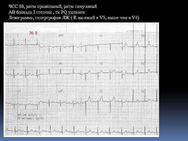 ЧСС 80, ритм правильный, ритм синусовый АВ блокада I степени , тк PQ удлинен
