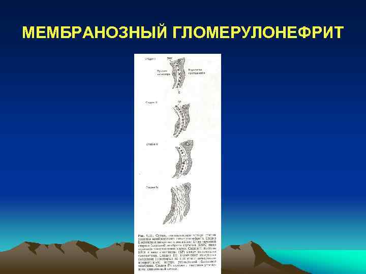 МЕМБРАНОЗНЫЙ ГЛОМЕРУЛОНЕФРИТ 